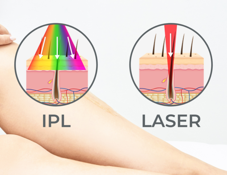 IPL Laser VS Laser IPL Laser VS Laser